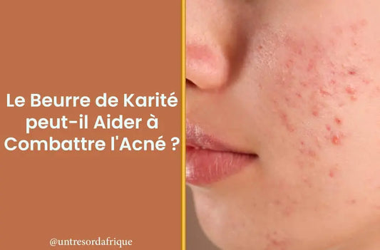 Le Beurre de Karité peut-il Aider à Combattre l'Acné ?